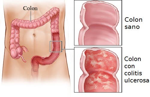 Tratamientos caseros para la colitis ulcerosa