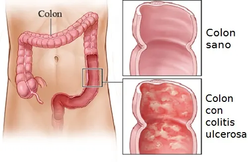 Tratamientos caseros para la colitis ulcerosa