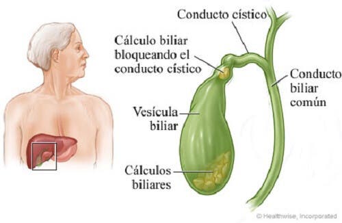 Cálculos en la vesícula