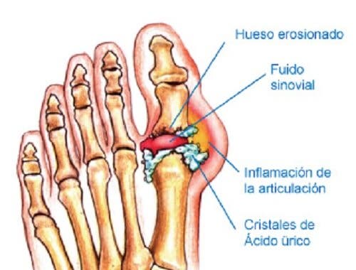 Dile adiós a la gota con este potente tratamiento natural