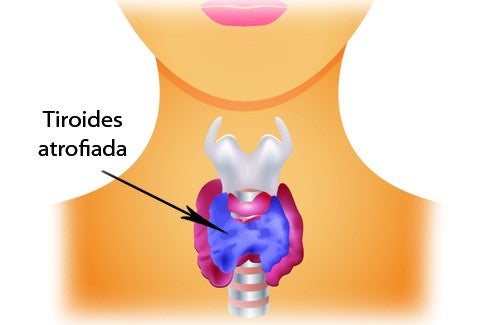 El hipotiroidismo se presenta cuando la tiroides está poco estimulada y produce menos hormonas de las necesarias