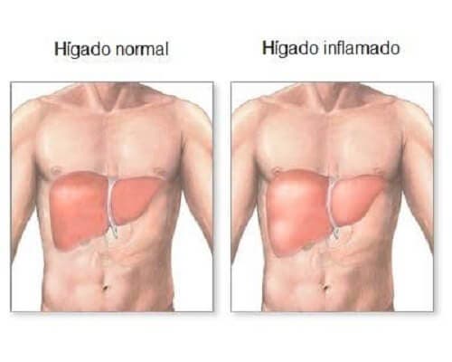 ¿Cómo saber si nuestro hígado está inflamado?