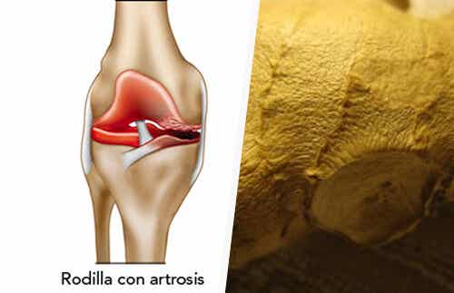 Cómo aliviar los síntomas de la artrosis