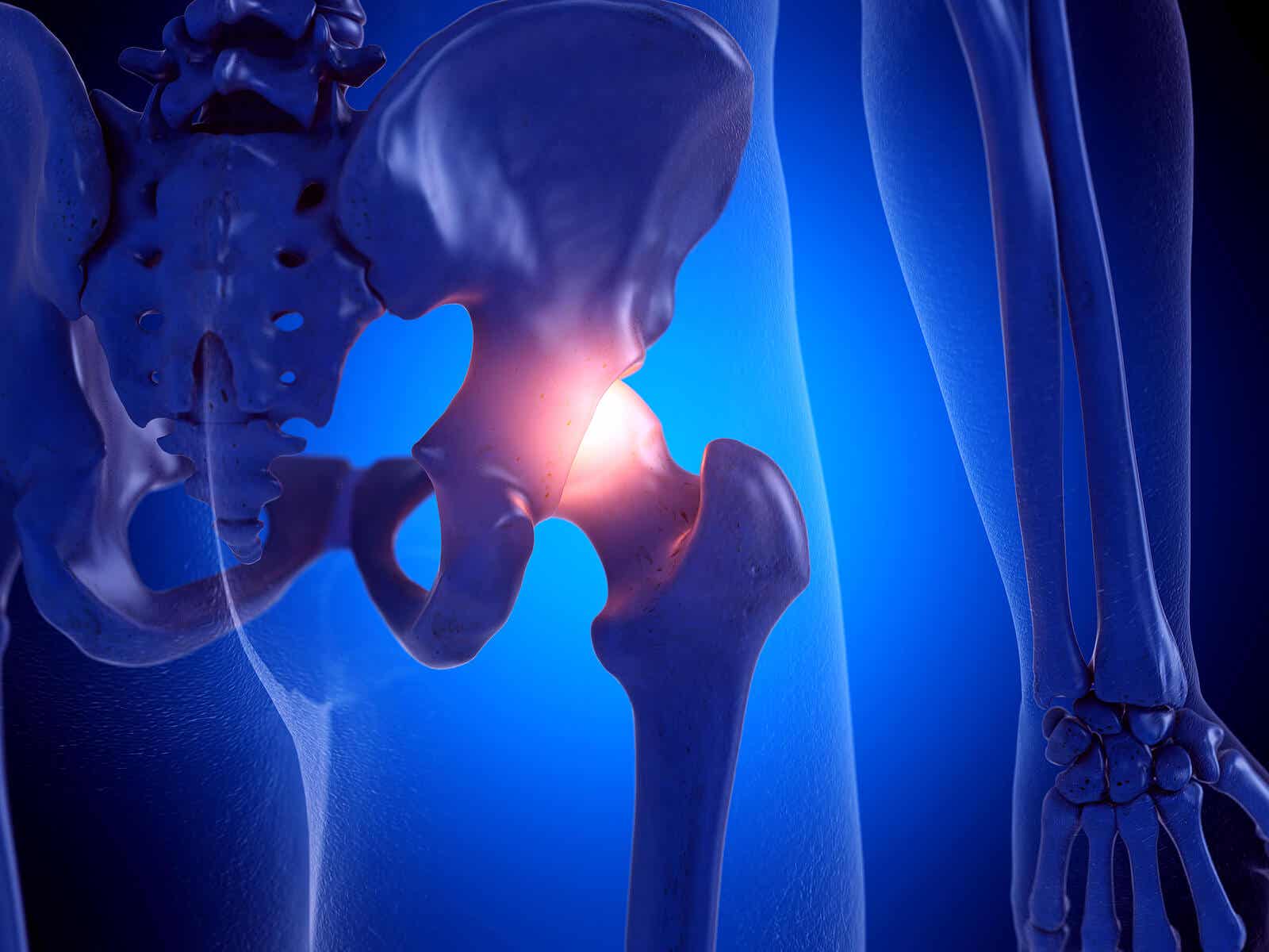 Desgaste de cadera: síntomas y prevención