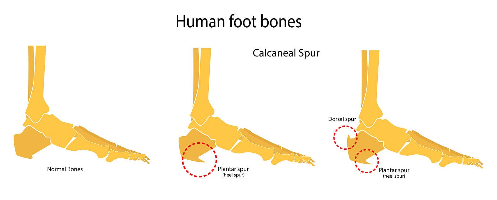 Huesos de los pies: espolón calcáneo.