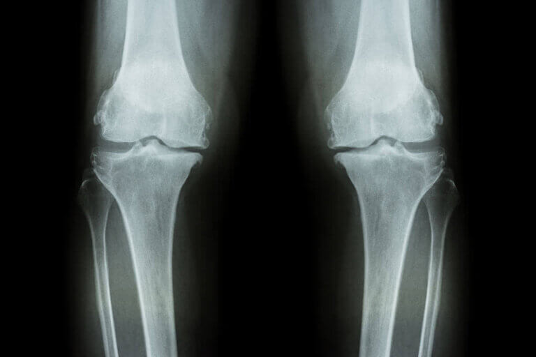 Síntomas del desgaste de rodilla