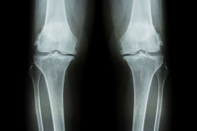 Síntomas del desgaste de rodilla