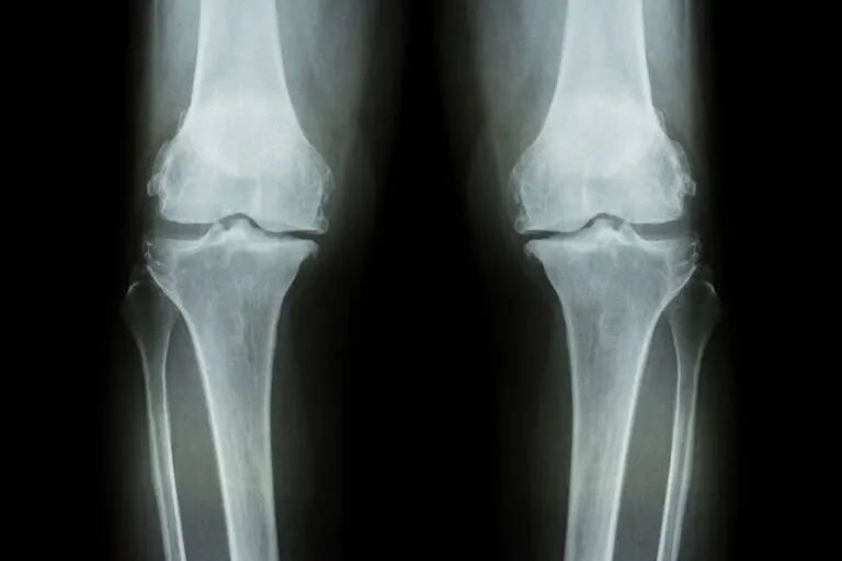 Síntomas del desgaste de rodilla