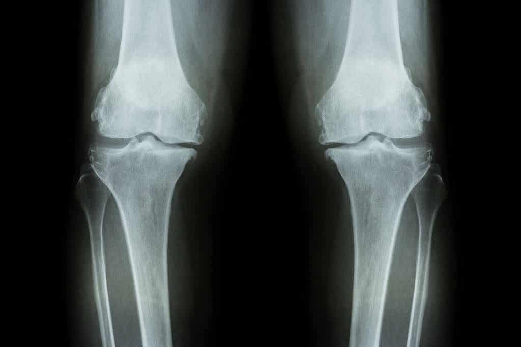 Síntomas del desgaste de rodilla