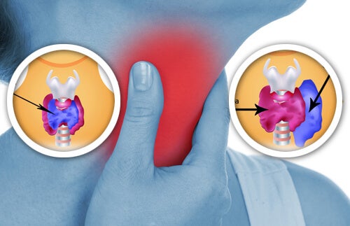 ignorancia Mount Bank Retorcido Cómo detectar a tiempo anomalías en la tiroides - Mejor con Salud