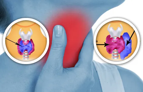 Problèmes de thyroïde