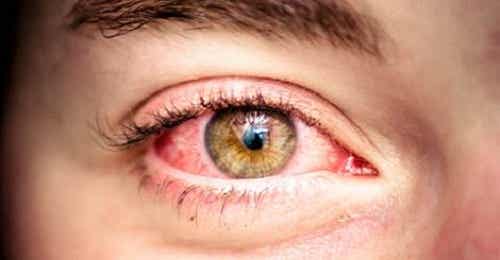 6 remedios para aliviar el enrojecimiento en los ojos
