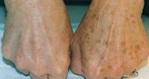 Cómo atenuar las manchas de la piel con plantas medicinales
