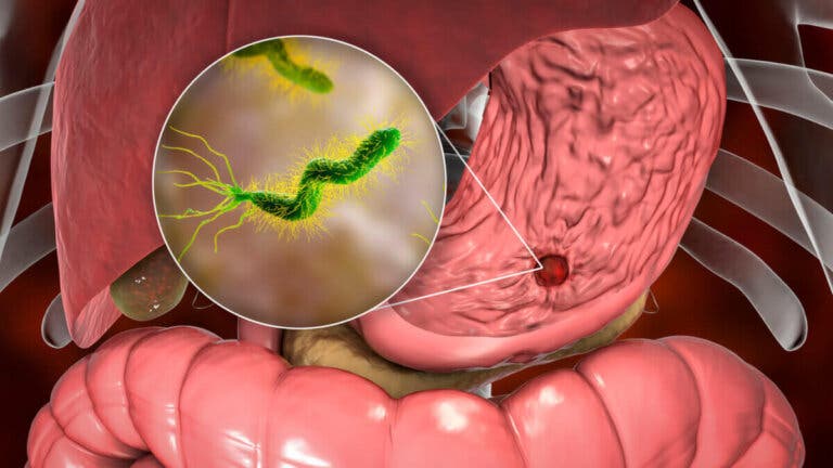 12 tratamientos naturales para combatir la bacteria Helicobacter pylori