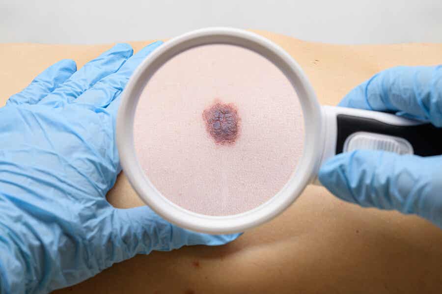 Señales de alarma que indican la presencia de cáncer de piel