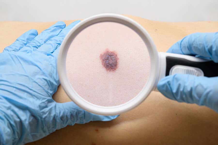 Cancro della pelle sotto forma di melanoma.
