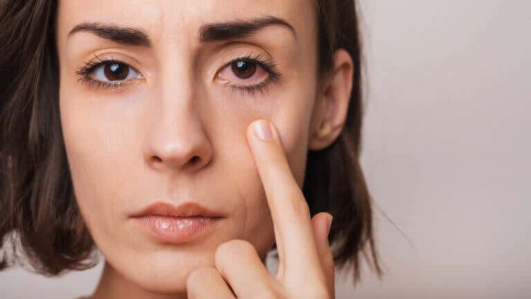 6 remedios para aliviar el enrojecimiento de los ojos