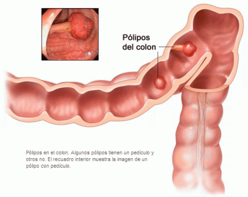 Pólipos en el colon