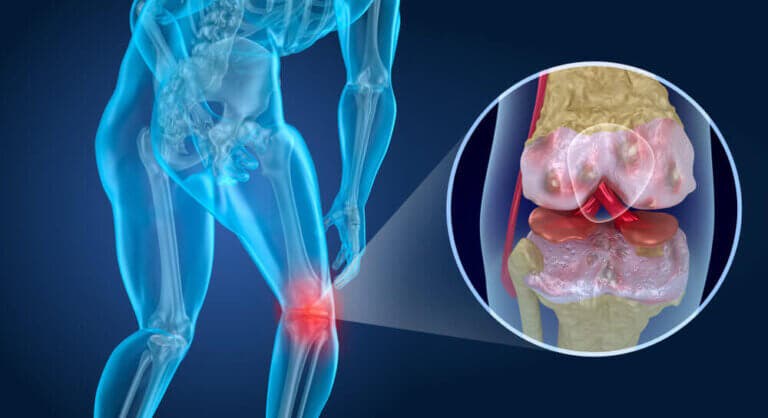 Qué es la artrosis: síntomas, prevención y tratamiento