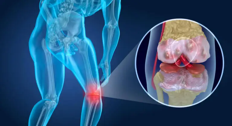 Qué es la artrosis: síntomas, prevención y tratamiento