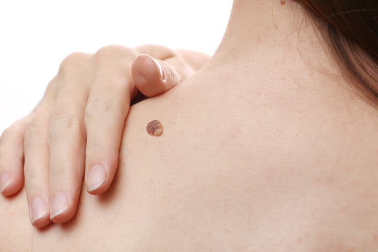 12 remedios naturales para eliminar las verrugas de tu cuerpo