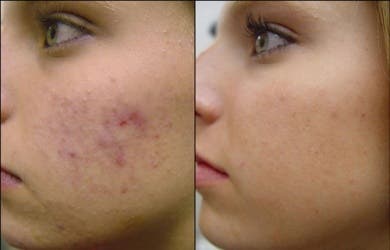 4 mascarillas caseras antiacné