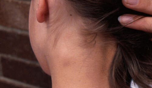Inflamación de un ganglio linfático: ¿qué debo hacer?