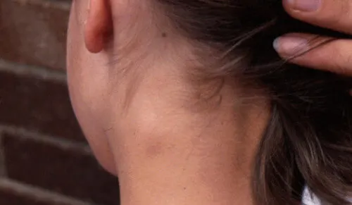 Inflamación de un ganglio linfático: ¿qué debo hacer?