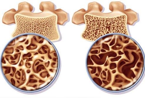 Cómo preparar un remedio rico en calcio para prevenir la osteoporosis