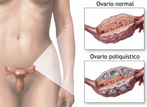 Tratamiento natural para el síndrome de ovarios poliquísticos