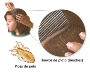 5 remedios caseros para combatir los piojos