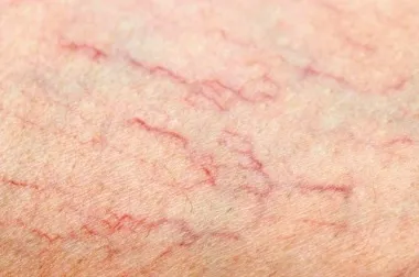 ¿Qué hago si me empiezan a salir varices?