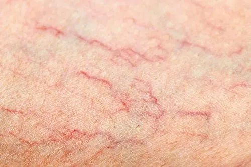 Varices