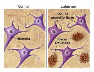 Comparación entre un cerebro normal y un cerebro con la enfermedad de Alzheimer