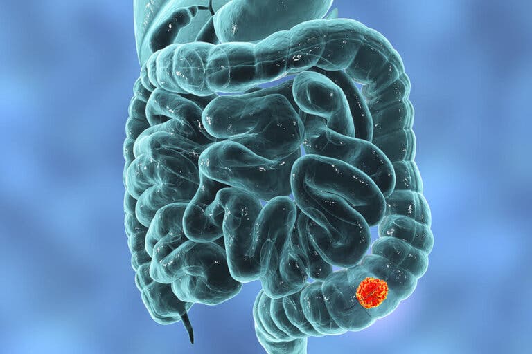 Síntomas del cáncer colorrectal en mujeres