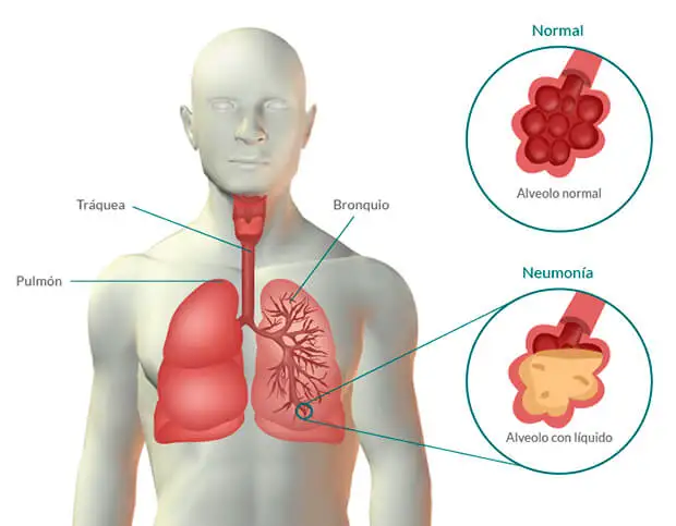 Neumonía: síntomas y remedios naturales complementarios