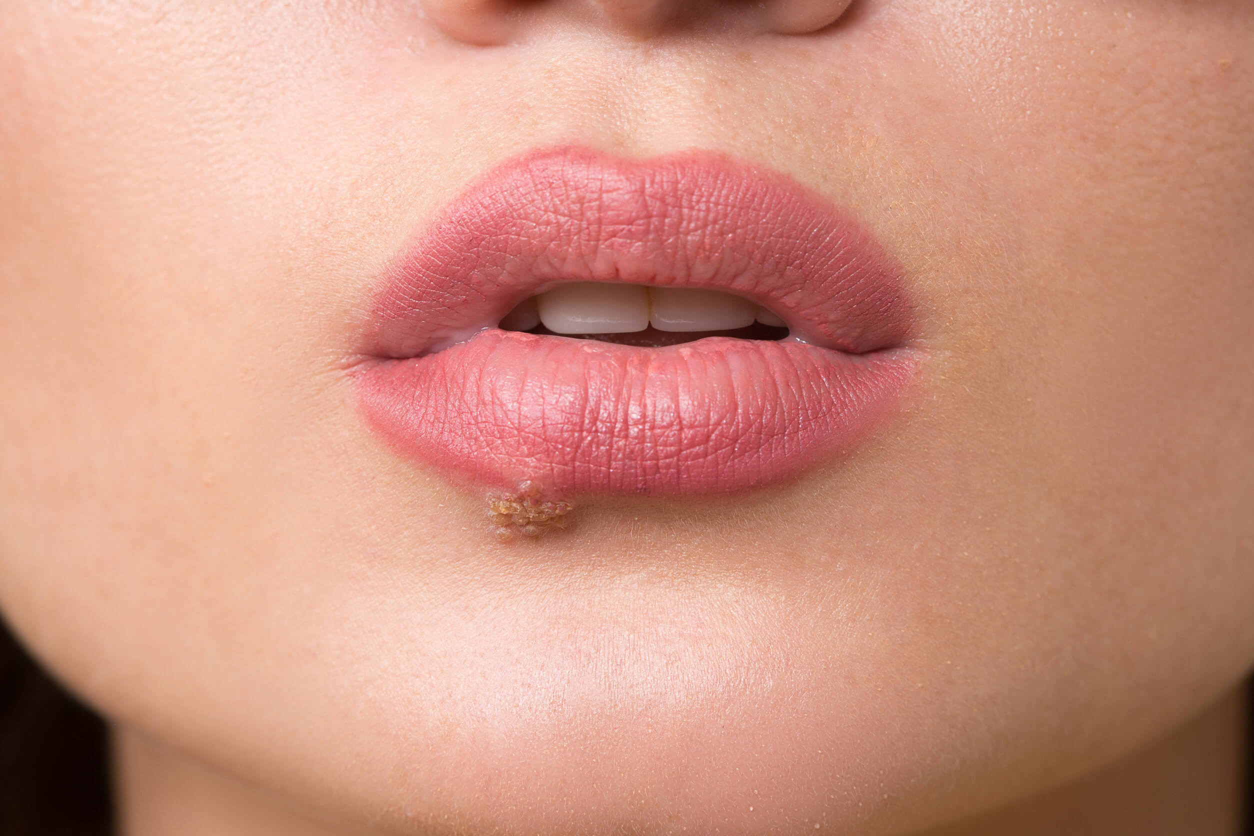 Mujer con herpes labial.