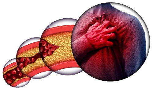 La obstrucción de las arterias coronarias y el peligro que representan para la salud