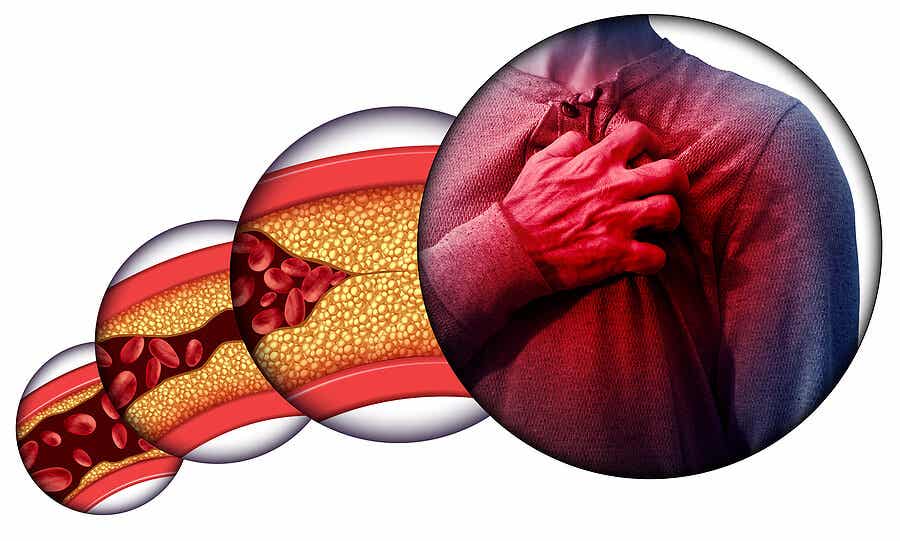 La obstrucción de las arterias coronarias y el peligro que representan para la salud