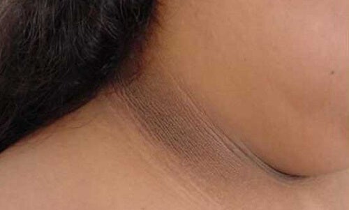 Reduce el oscurecimiento de la piel del cuello