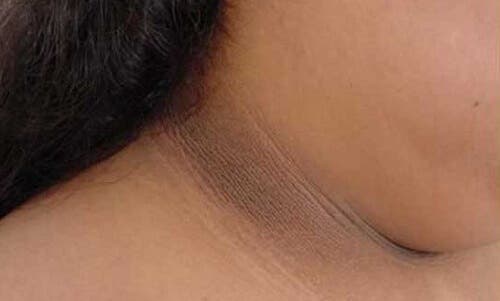 5 formas de quitar el cuello oscuro