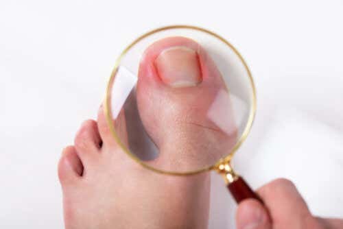 Tratamiento casero para las uñas encarnadas del pie