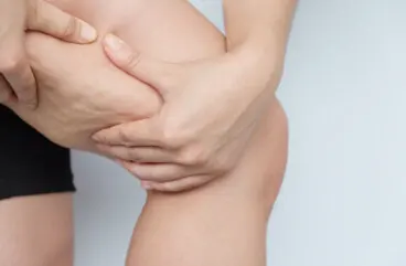 Cómo hacer una dieta para atenuar la celulitis