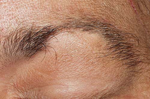 Alopecia en cejas y pestañas: ¿Qué tratamiento puedo seguir?
