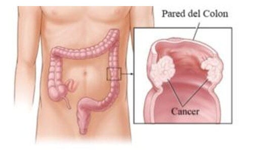 5 consejos para intentar prevenir el cáncer de colon