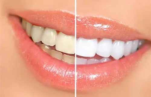 Dientes-amarillos