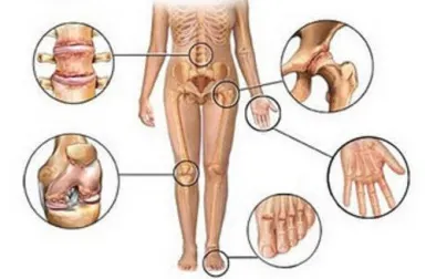 5 antiinflamatorios naturales para el dolor articular