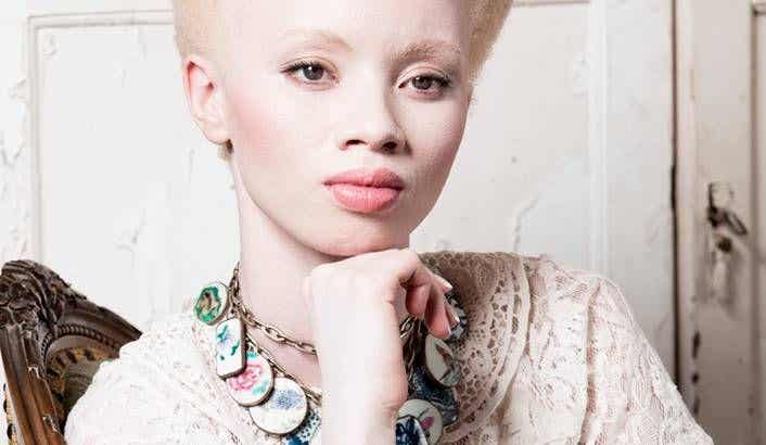 Albinismo: El conmovedor caso de la modelo Thando Hopa