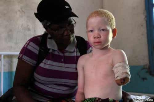 albinos-tanzania-16