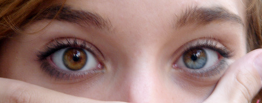heterocromia